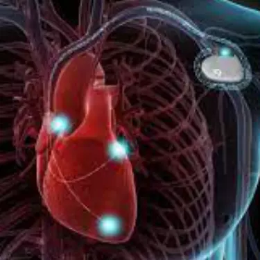 ICD Heart Device Implantation in Gurgaon India