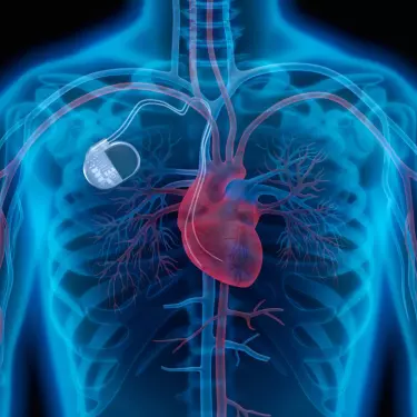 Pacemaker Implantation in gurgaon india